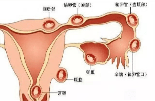 宫外孕术后输卵管堵塞的几率_宫外孕手术后输卵管阻是怎么回事_宫外孕手术输卵管堵塞