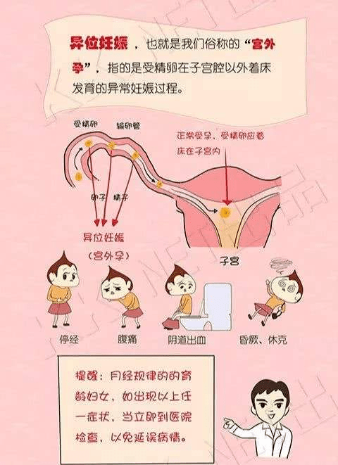 宫外孕术后输卵管堵塞的几率_宫外孕手术输卵管堵塞_宫外孕手术后输卵管阻是怎么回事